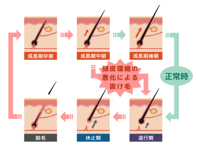 シャンプー 脱毛 抜け毛